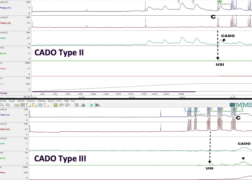 Figure 2. Urodynamics in women with cough-associated detrusor overactivity (CADO) types II and III. USI: Urodynamic stress incontinence (with permission) Image