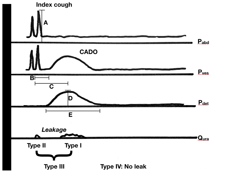 Figure 1. Types of cough-associated detrusor overactivity (CADO). Type I, leaks with CADO; II, leaks with cough (index cough or otherwise); III, leaks with both; and IV, no leak with either (with permission) Image